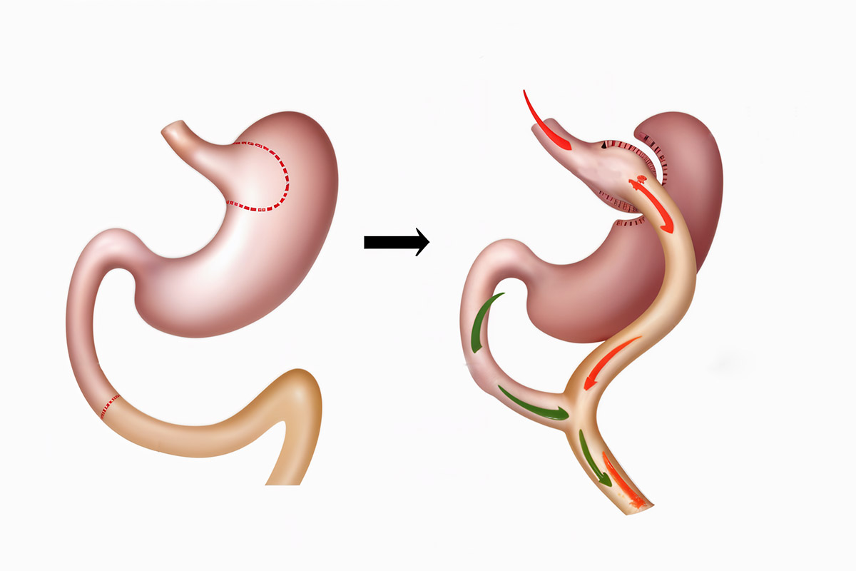 Gastric Bypass