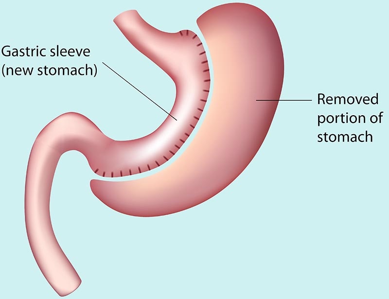 Gastric Sleeve