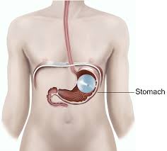 Gastric Balloons