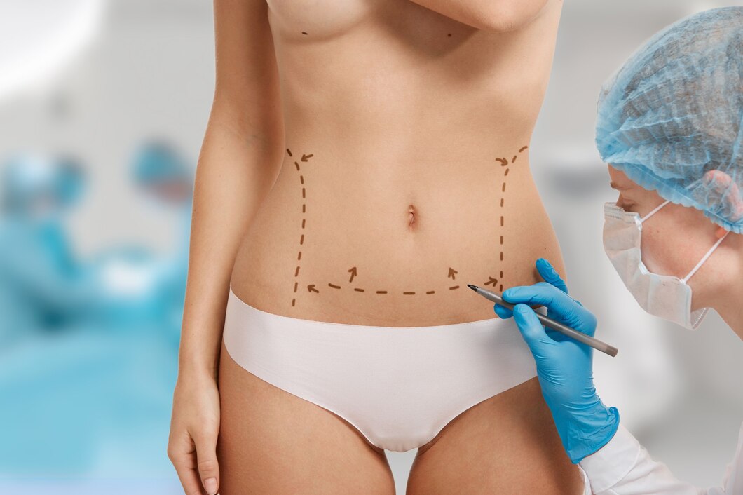 Tummy Tuck 